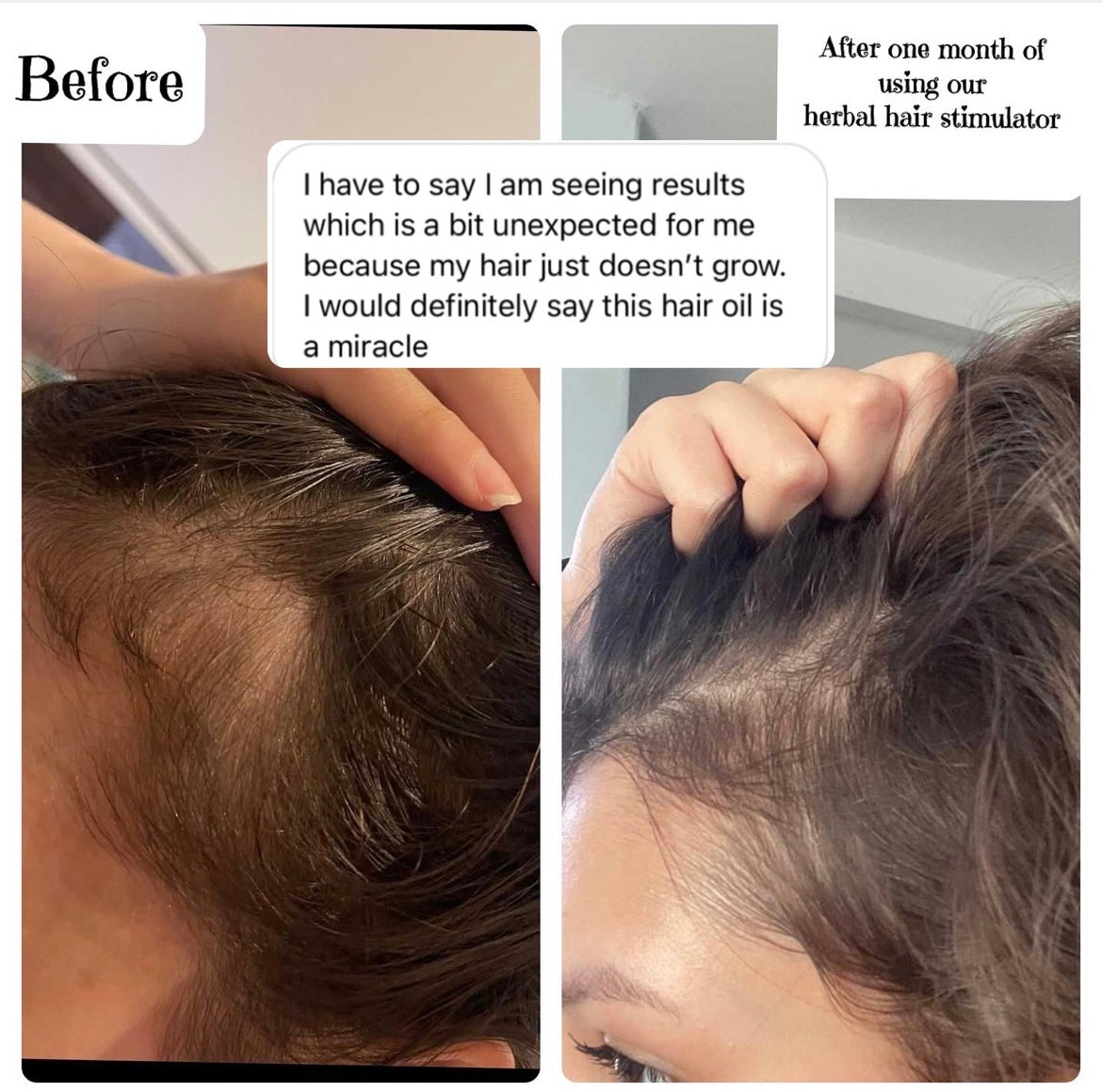 The Truth About Stress and Hair Loss: How Herbal Hair Stimulator Helps Reduce Shedding Naturally