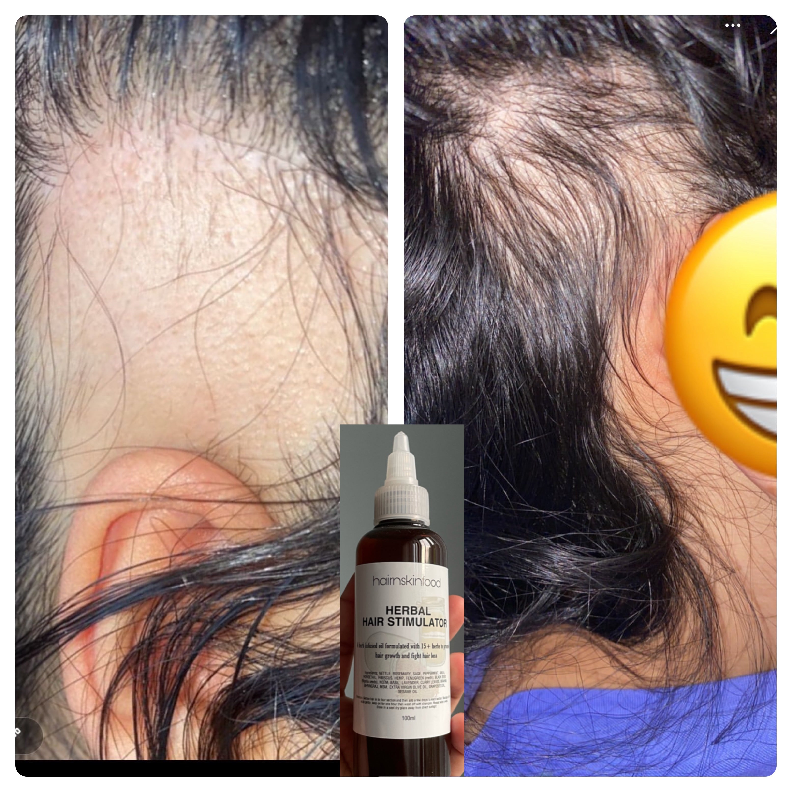 Best selling: Herbal Hair Stimulator